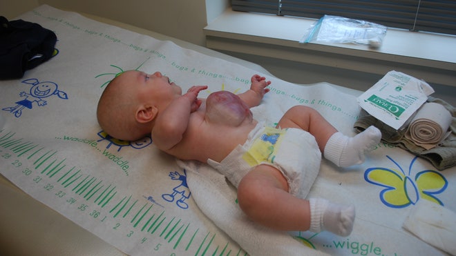 baby hayes 4 month checkup omphalocele.jpg